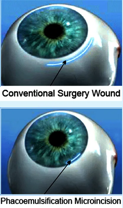 Phacoemulsification Microincision