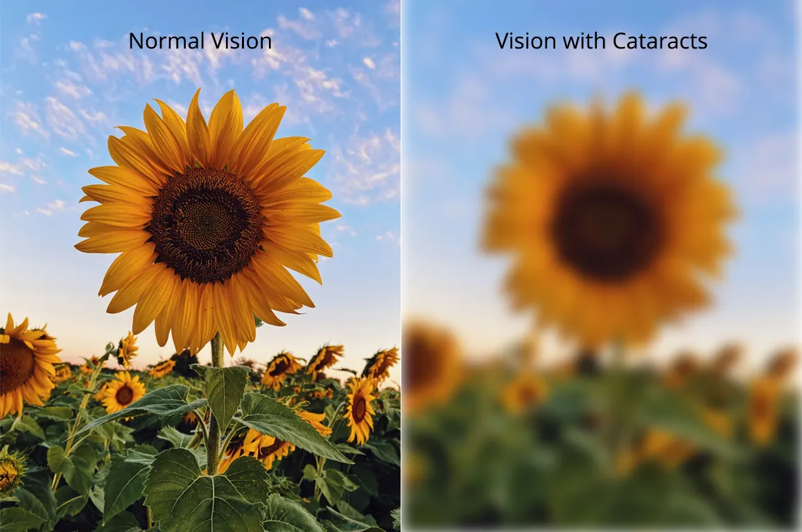 Normal Vision vs Cataract Vision
