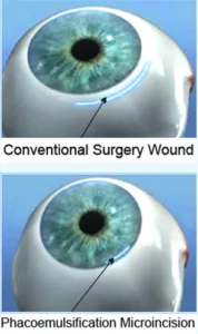 Conventional vs Phacoemulsification