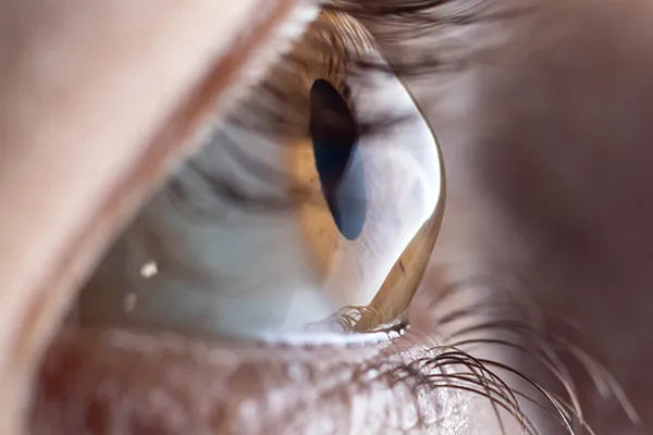 Keratoconus