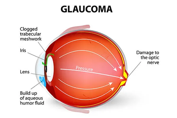 Glaucoma Treatment Stages