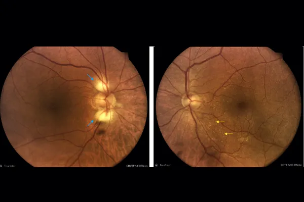 RNFL glaucoma test