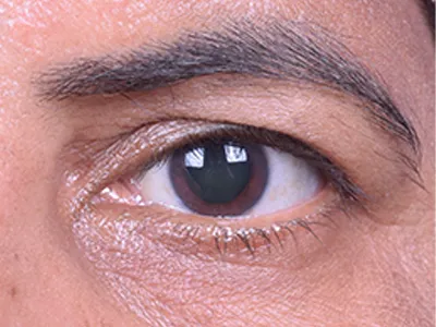 After Eyelid Tumor Removal