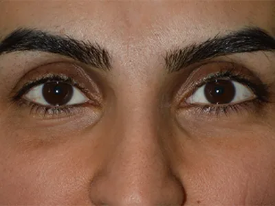 After Orbital Fracture Repair