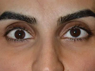 Before Orbital Fracture Repair