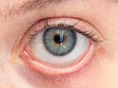 After Pterygium Surgery