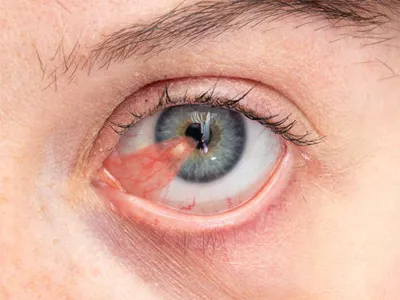 Before Pterygium Surgery