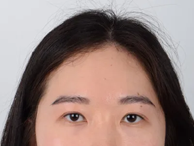 After Ptosis Correction