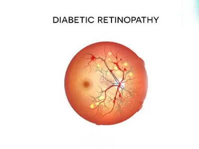 Diabetic retinopathy treatment