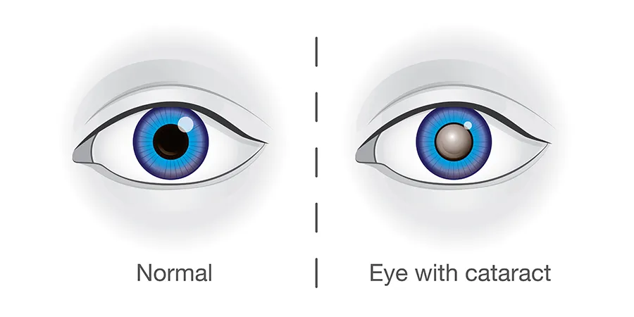 Eye cataract treatment Punjab