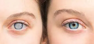 Clear vision after cataract surgery