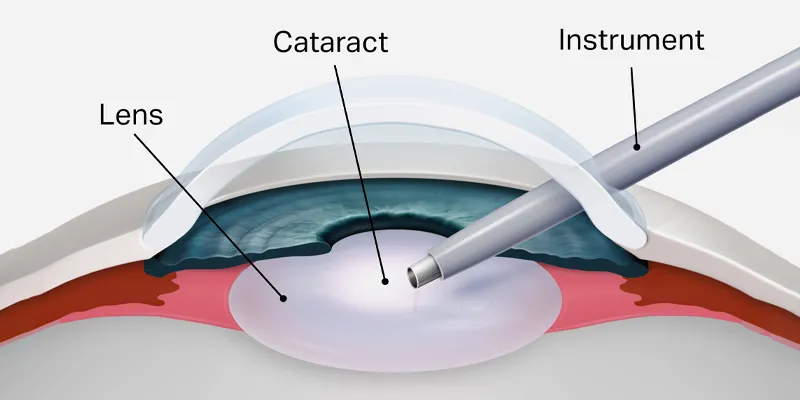 Modern cataract surgery