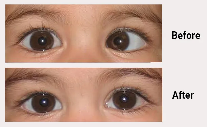 Squint Eye Surgery Success