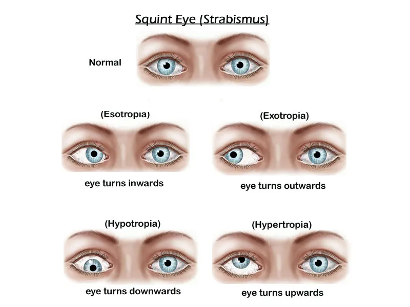 Best Age for Squint Eye Surgery in Children